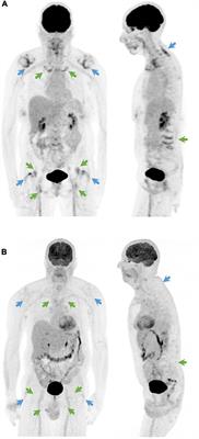 Diagnostic accuracy and validation of 18F-fluorodeoxyglucose positron emission tomography scores in a large cohort of patients with polymyalgia rheumatica